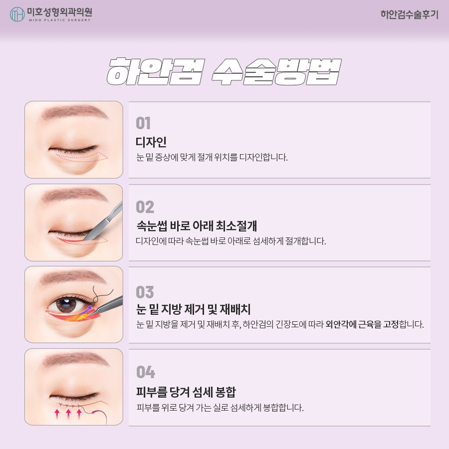 하안검수술후기 주인공이 되는 법 관련 이미지 4