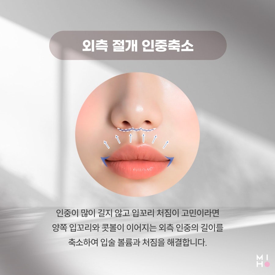 인중축소 중안부 짧은 동안 얼굴로 관련 이미지 19