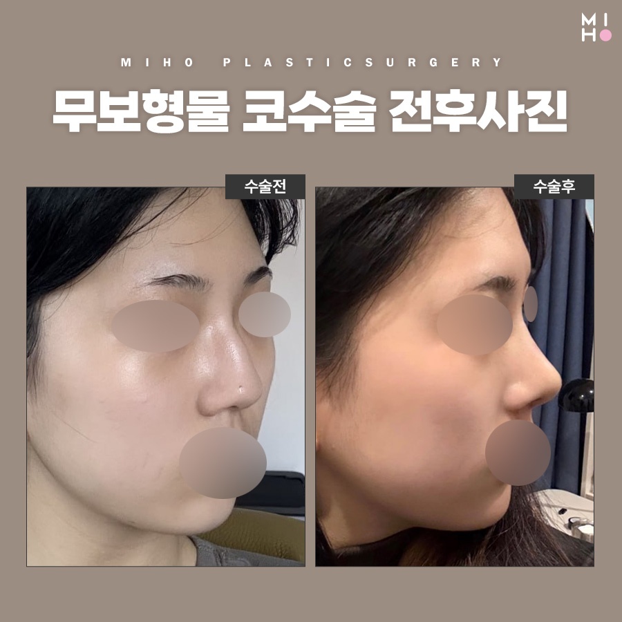무보형물코수술 부담 없는 모양 개선 관련 이미지 10