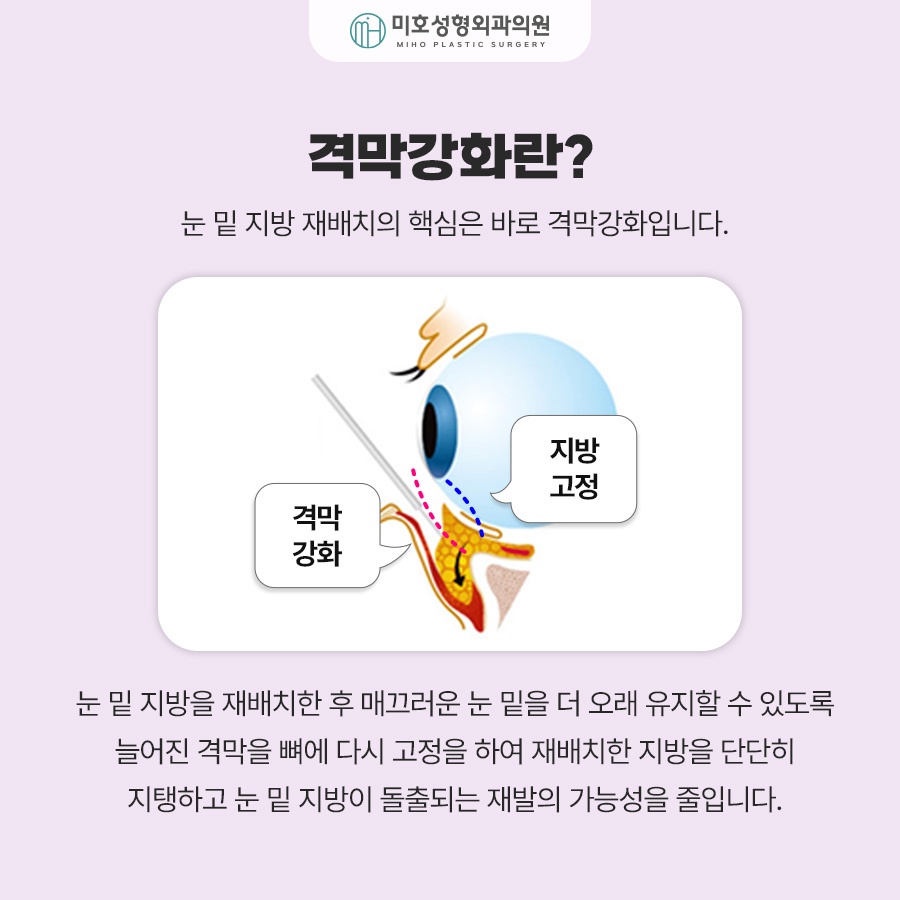 To Learn About Under-Eye Fat Graft Reviews, Methods, Swelling, and Recovery image 4