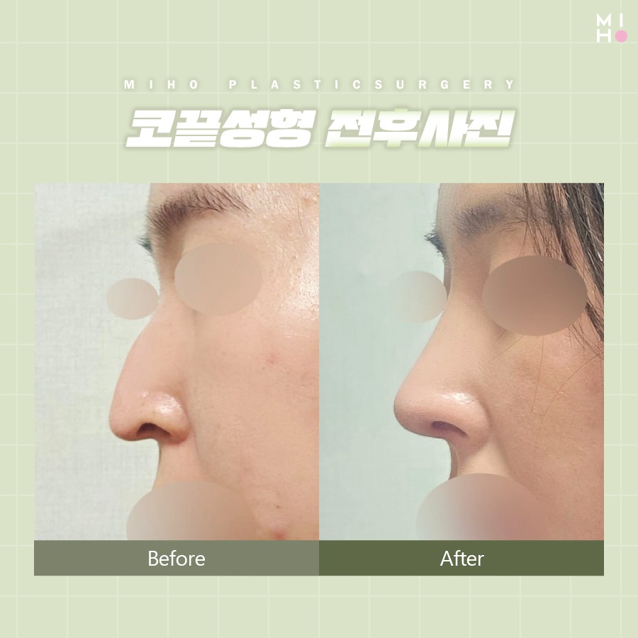 코끝성형 오똑하고 자연스럽게 관련 이미지 7