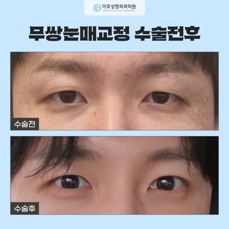 무쌍눈매교정 전후 차이를 비교해보고 관련 이미지 8