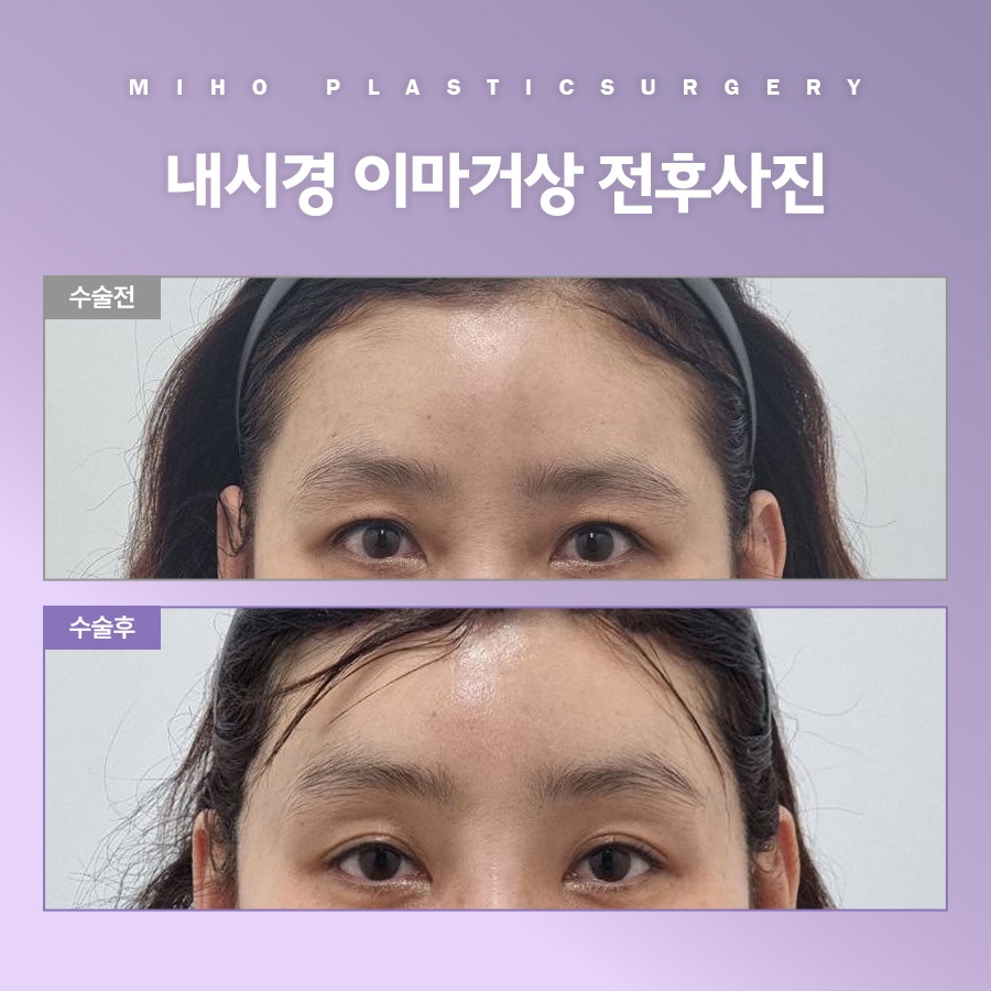 이마거상 비용 및 사후관리 팁 관련 이미지 8