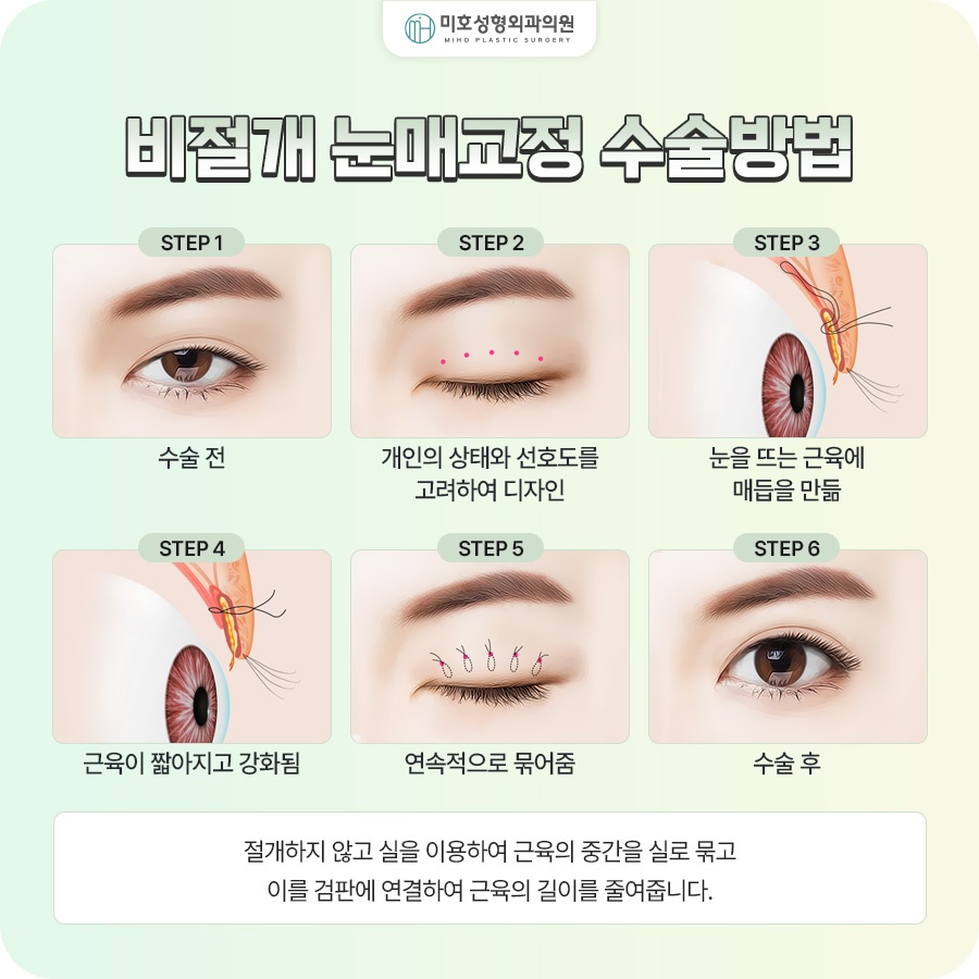 남자눈매교정 졸려 보이는 인상이 고민이라면 관련 이미지 6