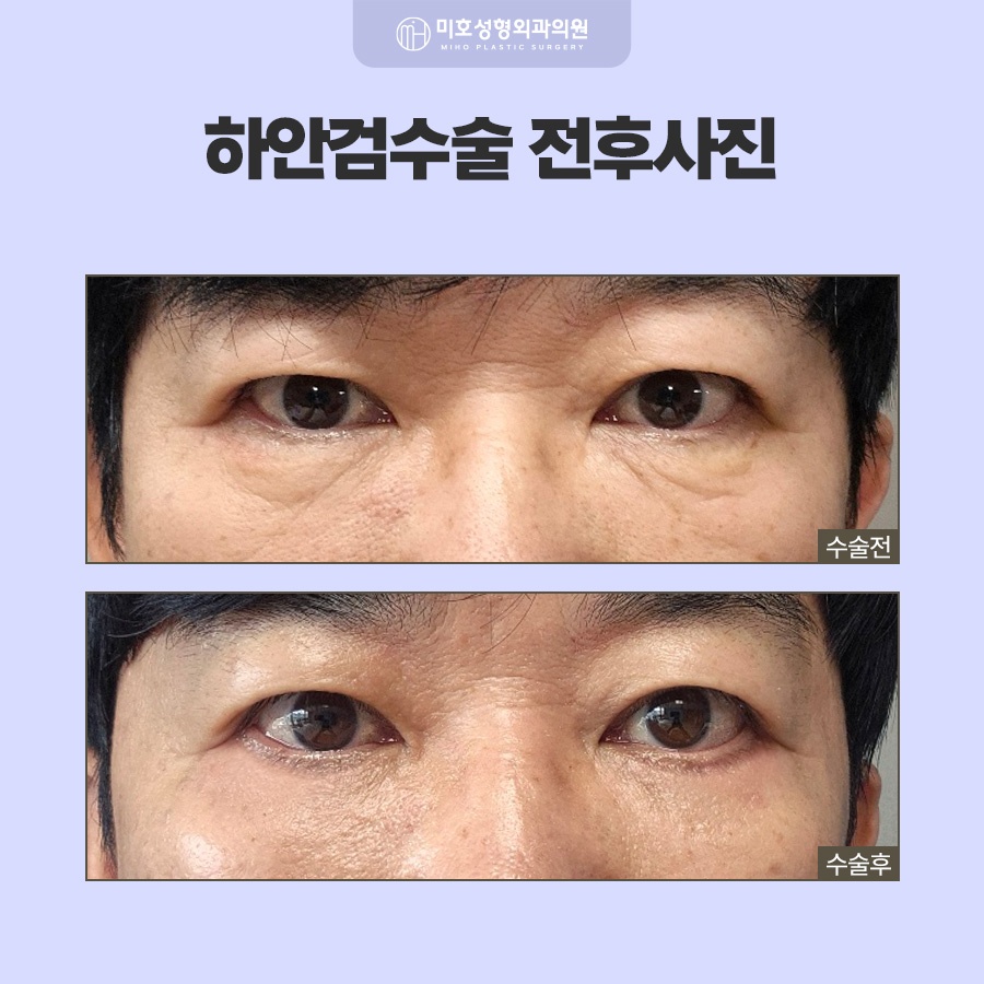 하안검수술 아래쪽 변화가 고민이라면 관련 이미지 6