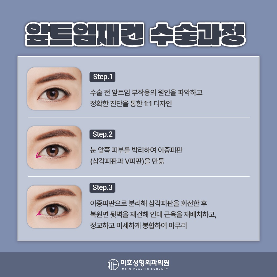 앞트임재건 미세함의 차이로 관련 이미지 5