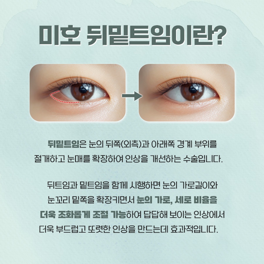 뒷트임밑트임후기 주의할 점 관련 이미지 2