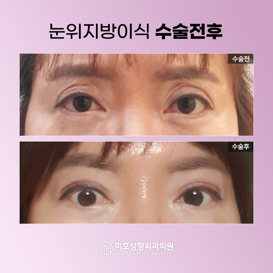 How to Naturally Improve Sunken Upper Eyelids image 7