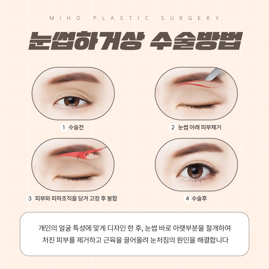 눈썹하거상 처진 눈꺼풀 또렷하게 관련 이미지 5