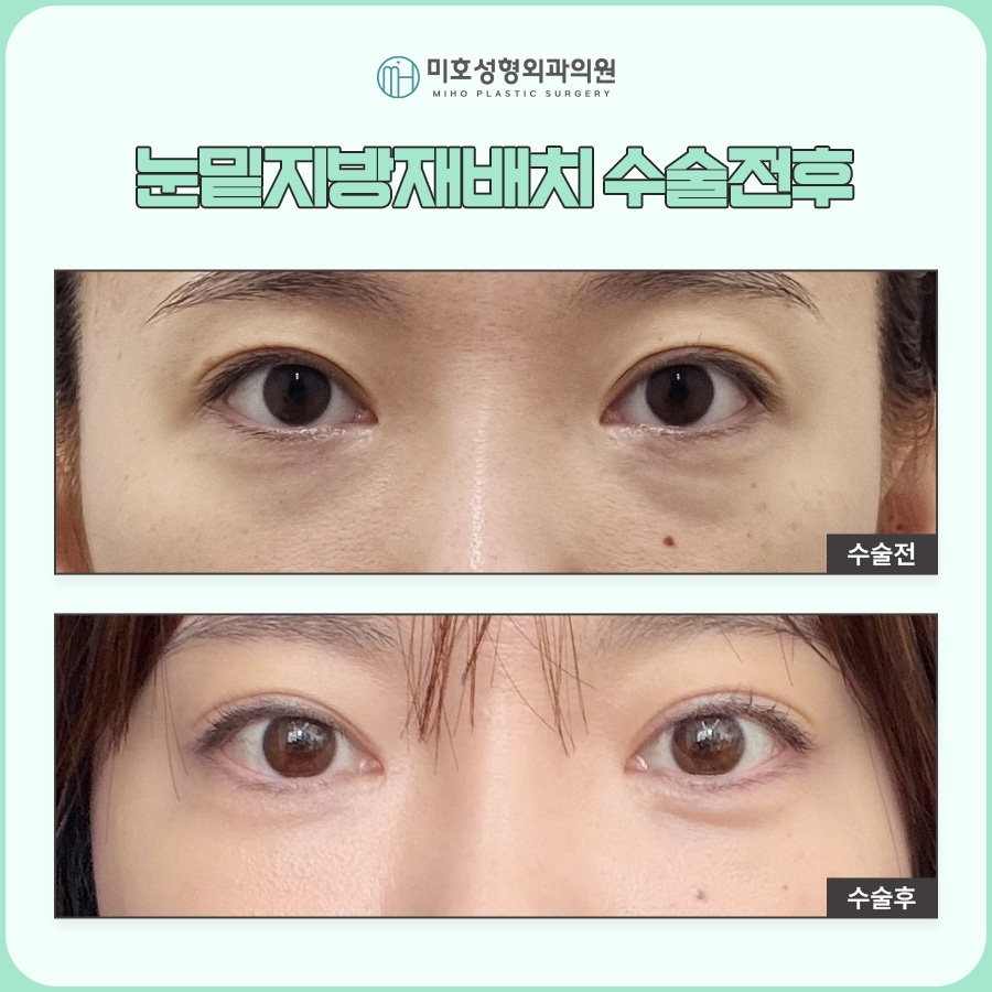눈밑지 후기보다 의료진 실력이 중요 관련 이미지 9