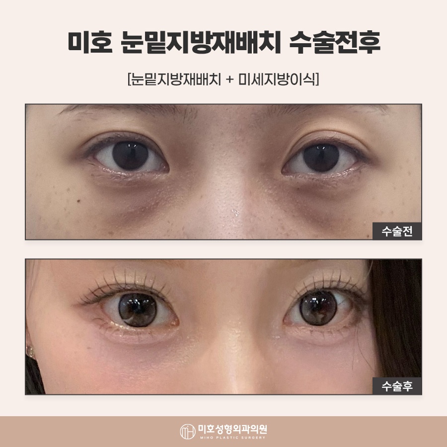 눈밑지방재배치수술후 회복 흐름 살펴봐야 관련 이미지 8