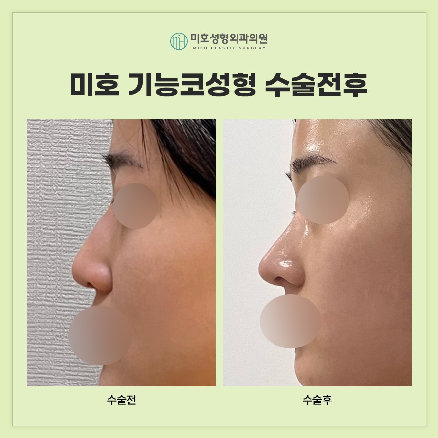 기능코 편안하고 아름다운 비결 관련 이미지 8