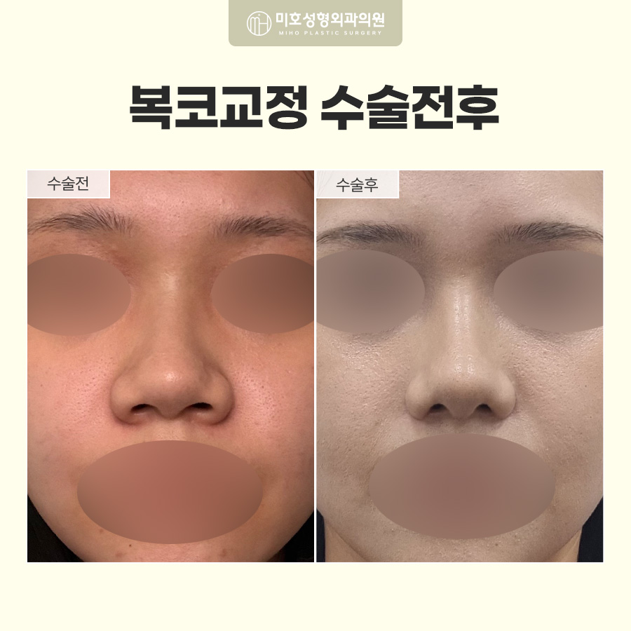 복코교정이란? 복코 원인부터 수술방법, 회복기간까지 알아보기 관련 이미지 10