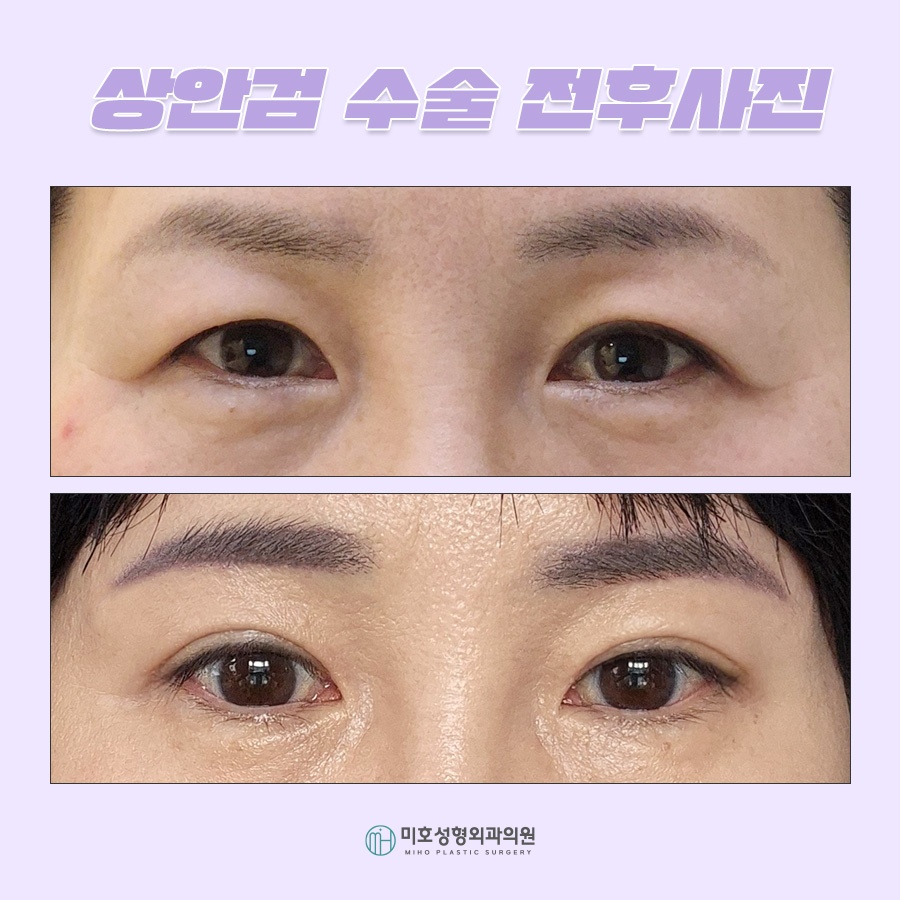상안검수술 해당하는 유형은 관련 이미지 7