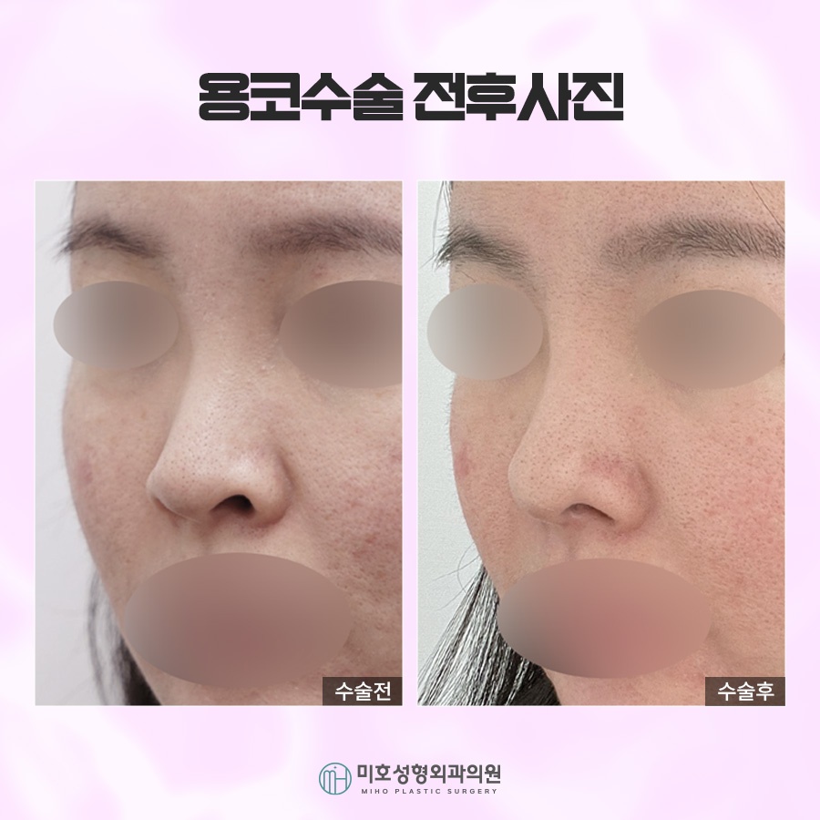 Through Drooping Nostril Correction in Bulbous Nose Surgery image 9