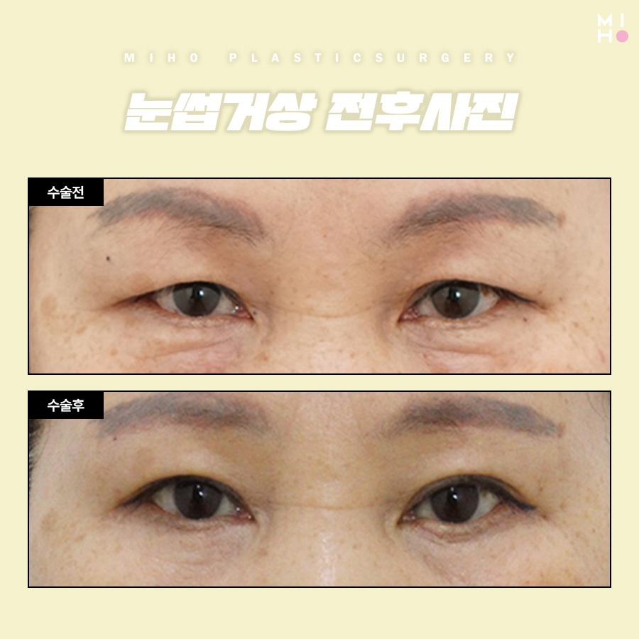 Brow Lift Review: You Could Be the Next Success Story image 8