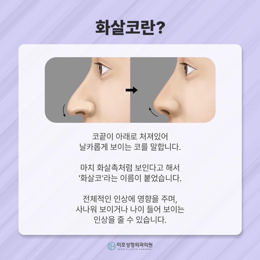 화살코 교정 방법 및 관리수칙 관련 이미지 2