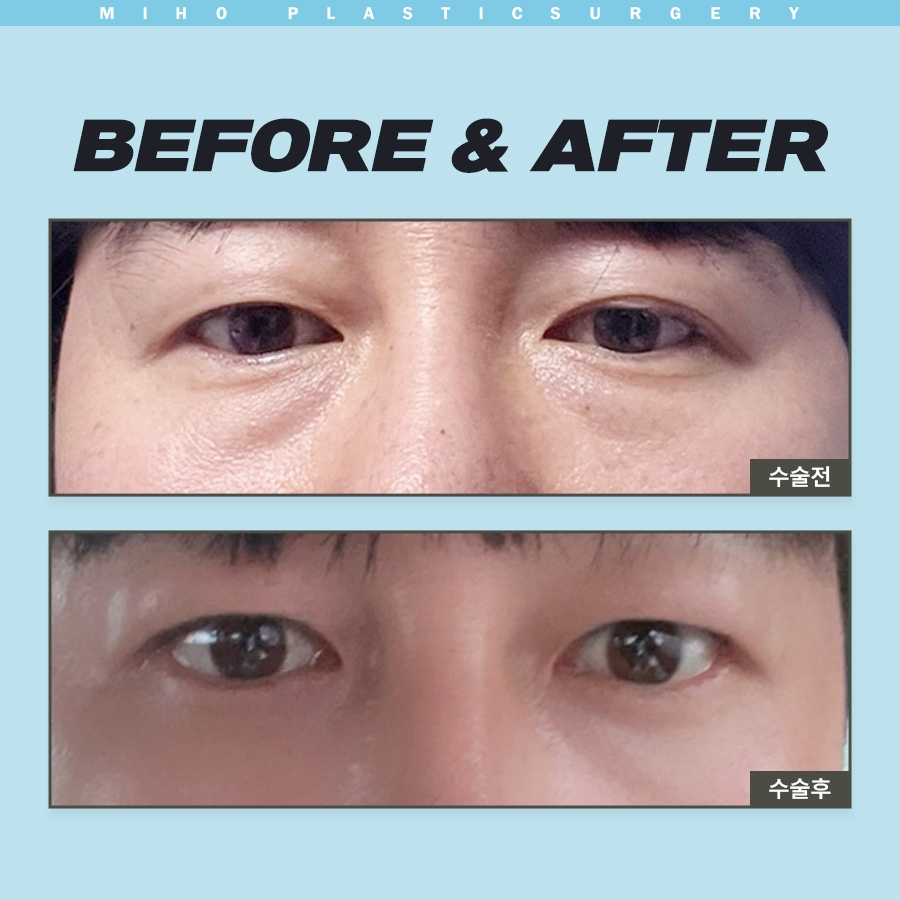 눈밑지방제거 하안검 다크써클 개선 방법 관련 이미지 9