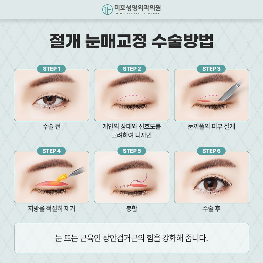 Naturally Defined Eyes with Male Eye-Shape Correction image 5
