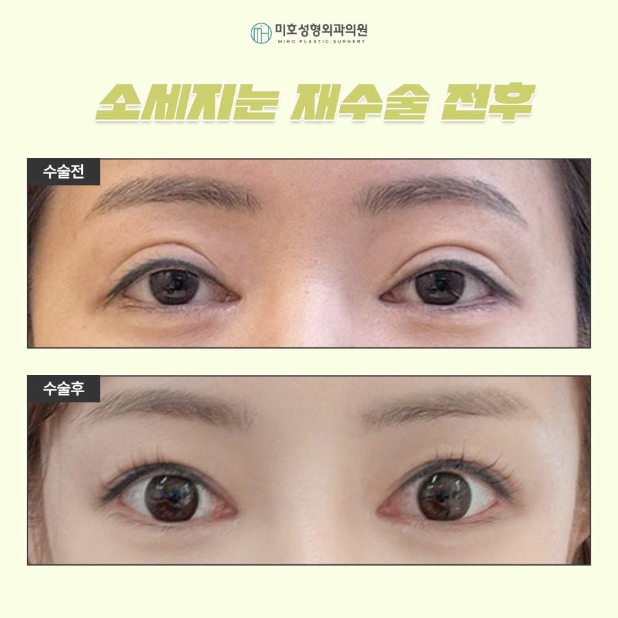 소세지눈재수술 고민된다면 관련 이미지 9