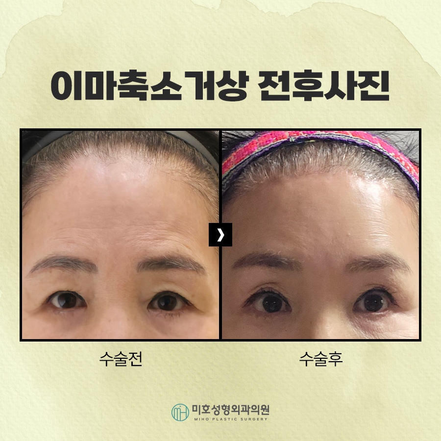 이마축소거상 부작용 더는 방법 관련 이미지 8