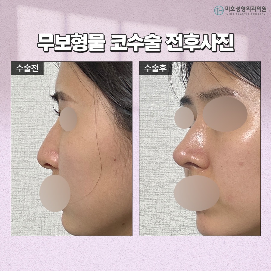 Criteria for Choosing Natural-Looking Implant-Free Rhinoplasty image 10