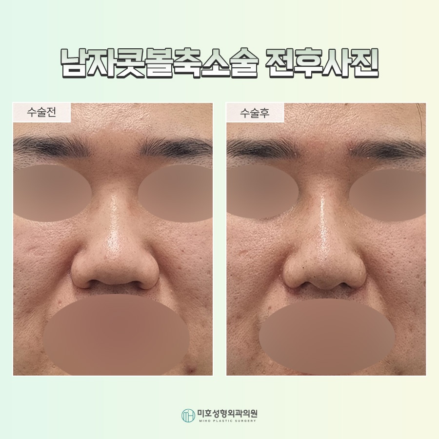A Successful Guide to Male Alar Reduction for a Refined Appearance image 9