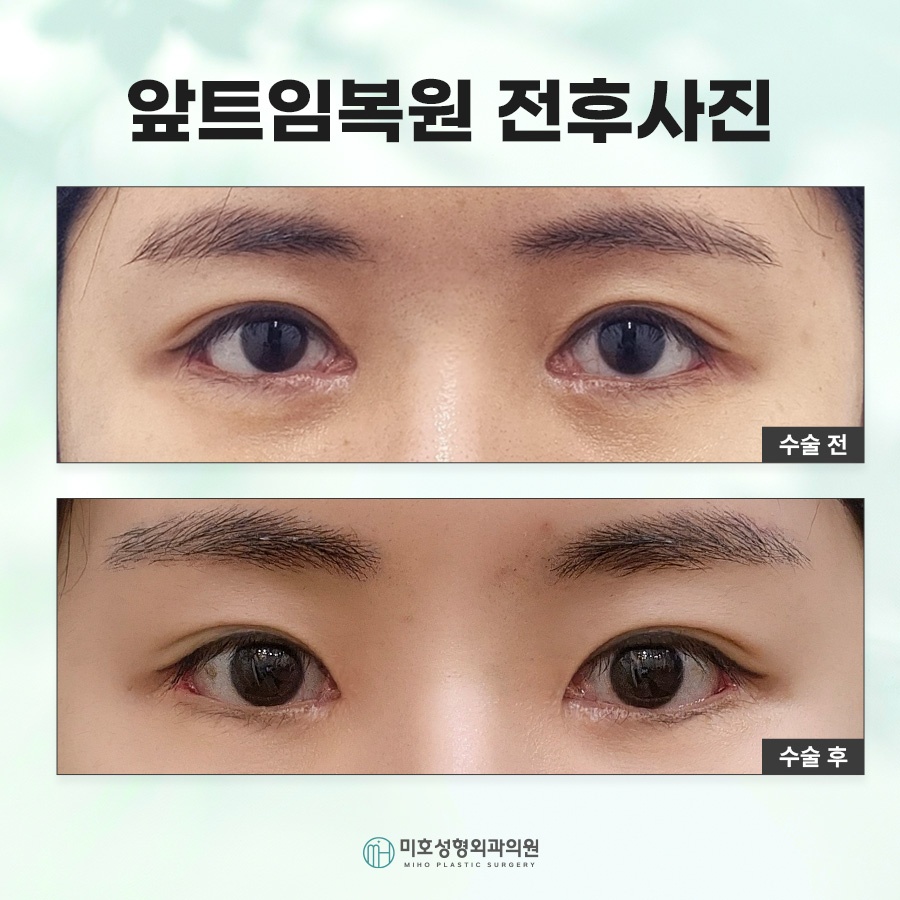 How Medial Canthoplasty Restoration Is Performed and Scar Care image 8
