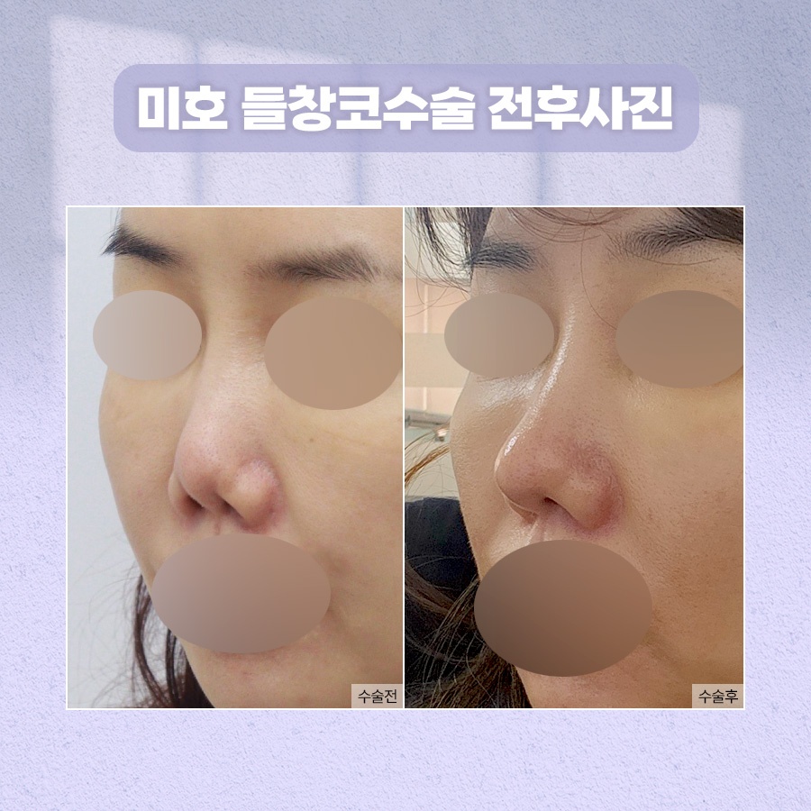 들창코수술 자연스러운 각도 기준 관련 이미지 9