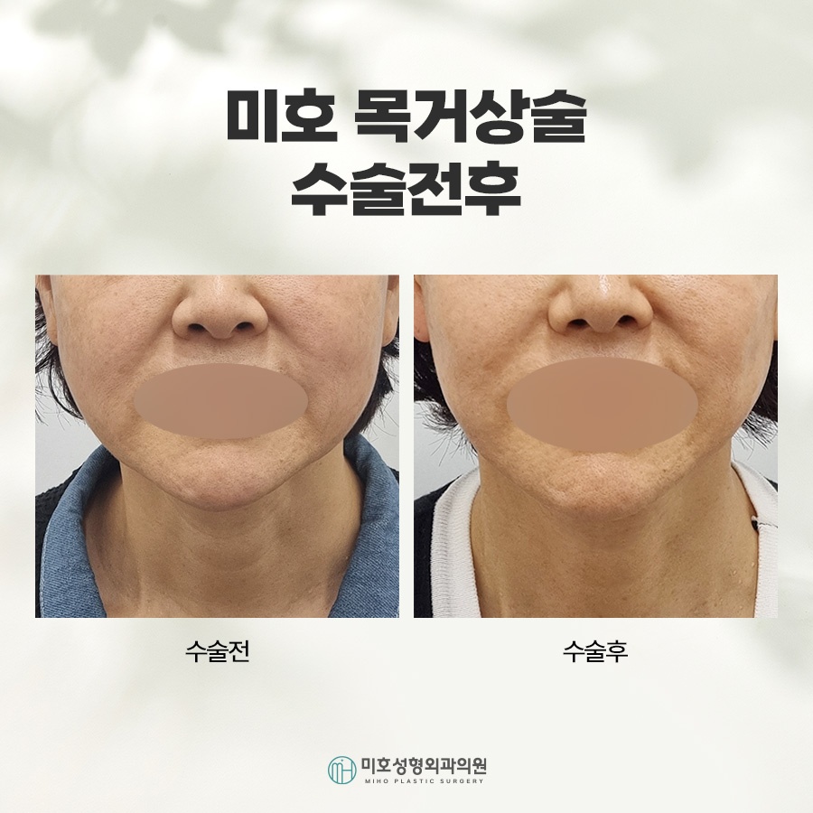 Neck Lift: A Lifting Method to Restore a Sagging Neckline image 6