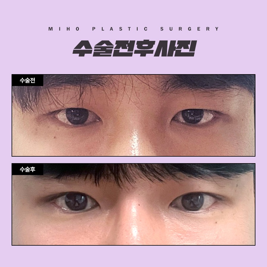 The Key to a Natural Image Transformation with Male Eyelid Surgery image 7
