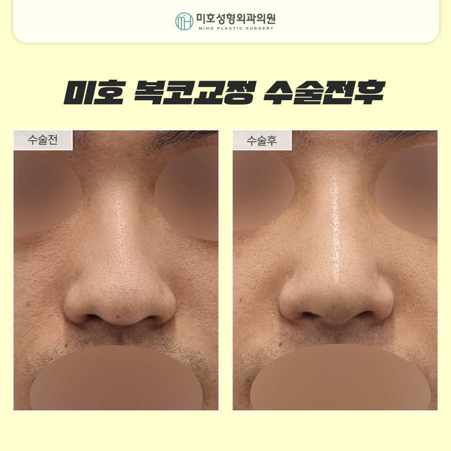 Naturally Improve the Bulbous Nose Complex image 9