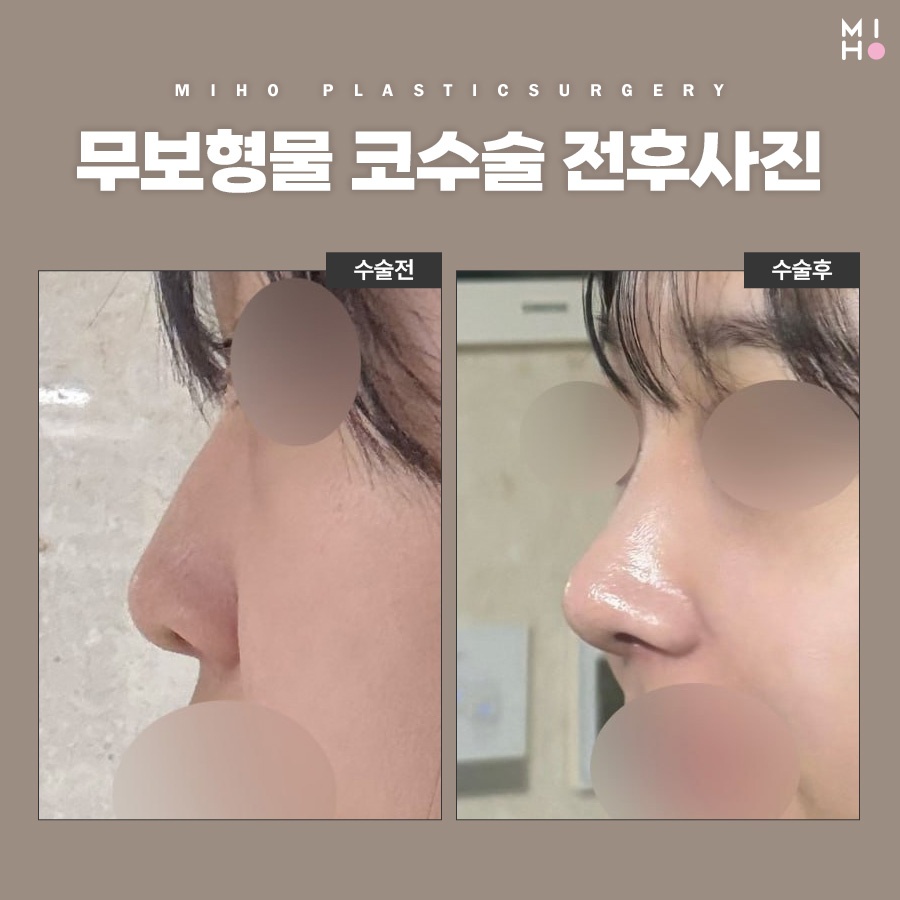 무보형물코수술 부담 없는 모양 개선 관련 이미지 9
