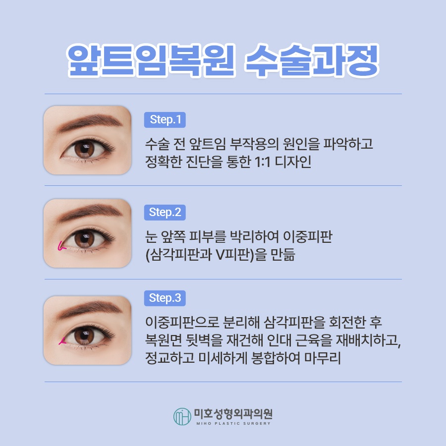 앞트임복원 및 라인 변화를 원한다면 관련 이미지 3