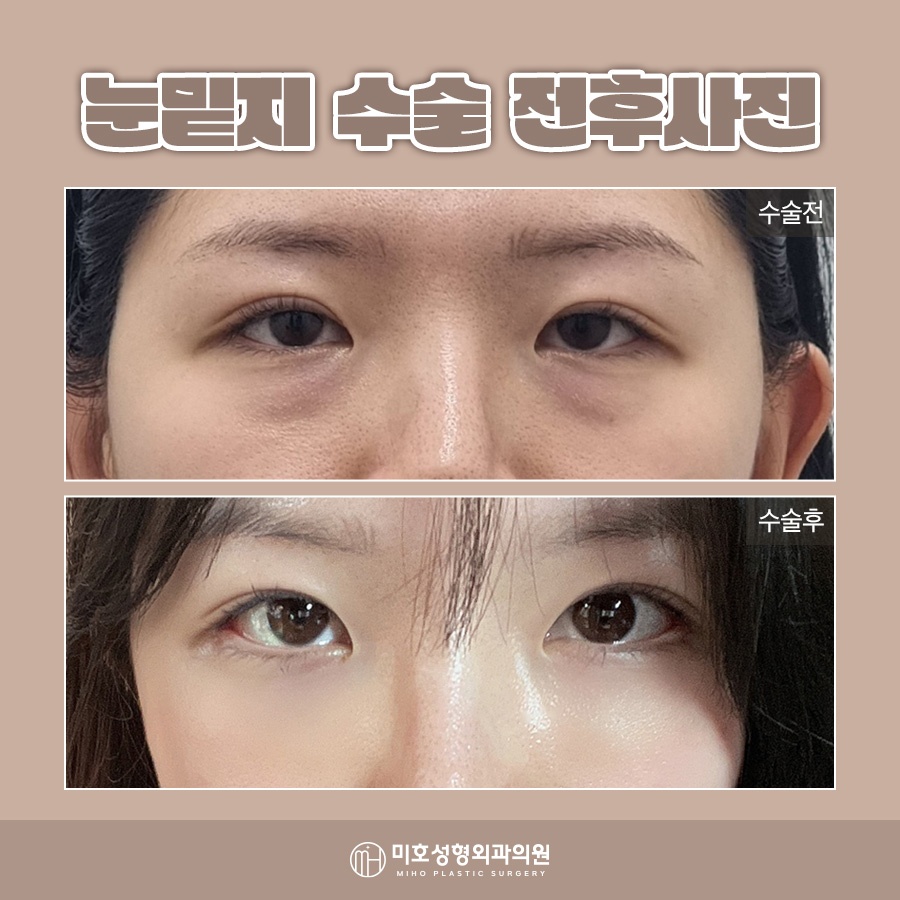 눈밑지붓기 원인 기간을 고려하여 관련 이미지 8
