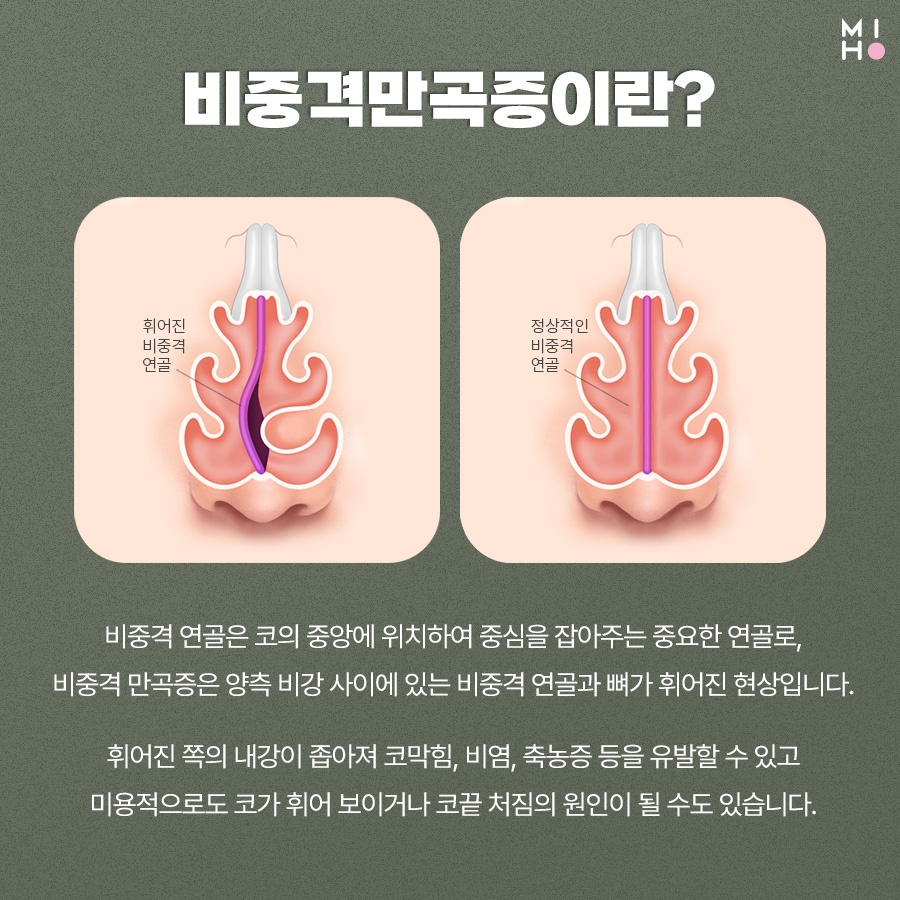 비중격만곡증 비용부담은 줄이고 만족도는 높여요 관련 이미지 2
