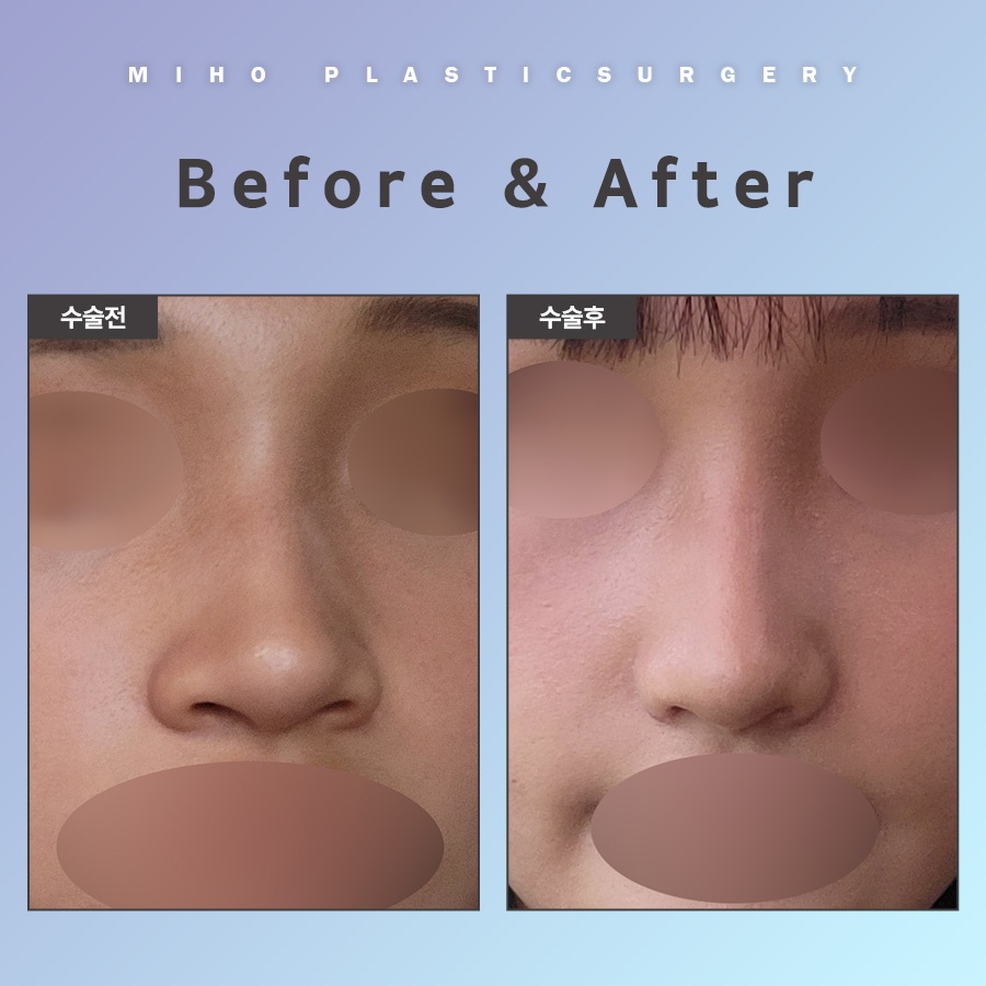 Natural-Looking Alar Reduction with Minimal Incisions image 6