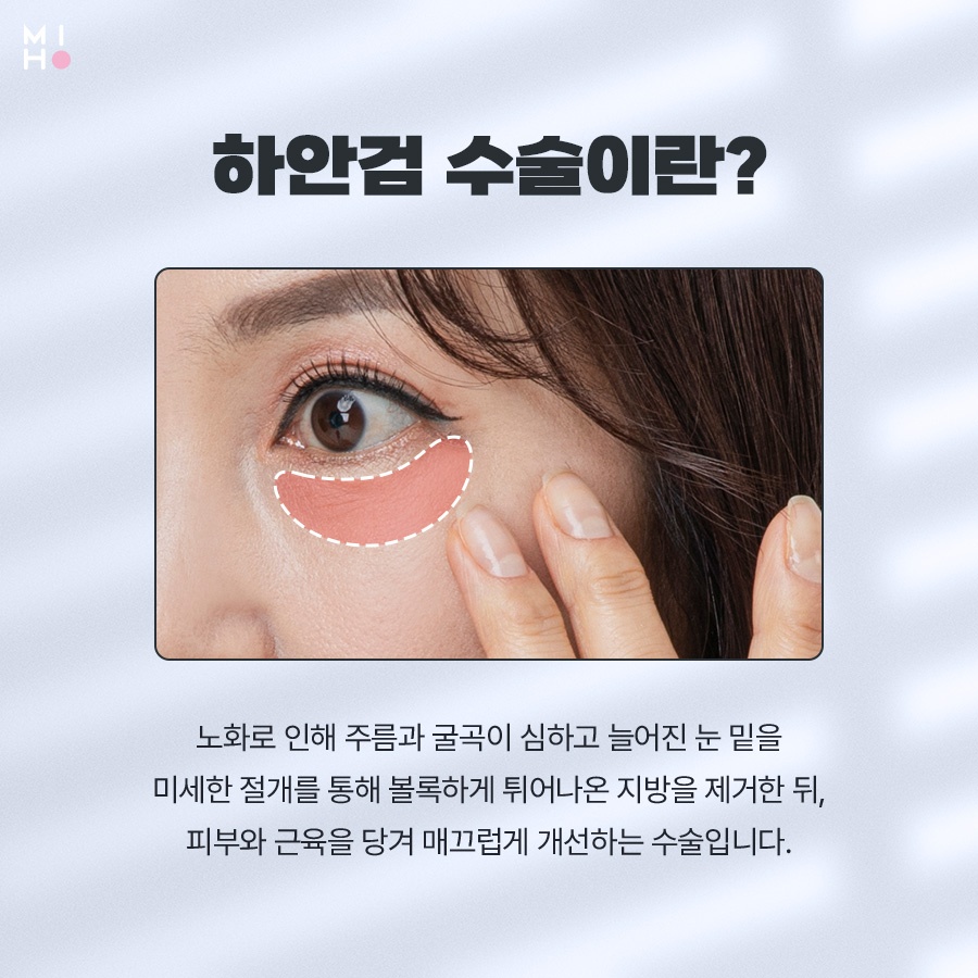 하안검수술 이미지 변신도 안전하게 관련 이미지 2