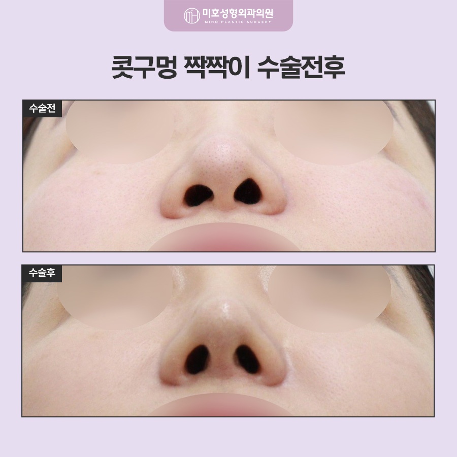 콧구멍짝짝이 원인과 교정 방향 관련 이미지 9