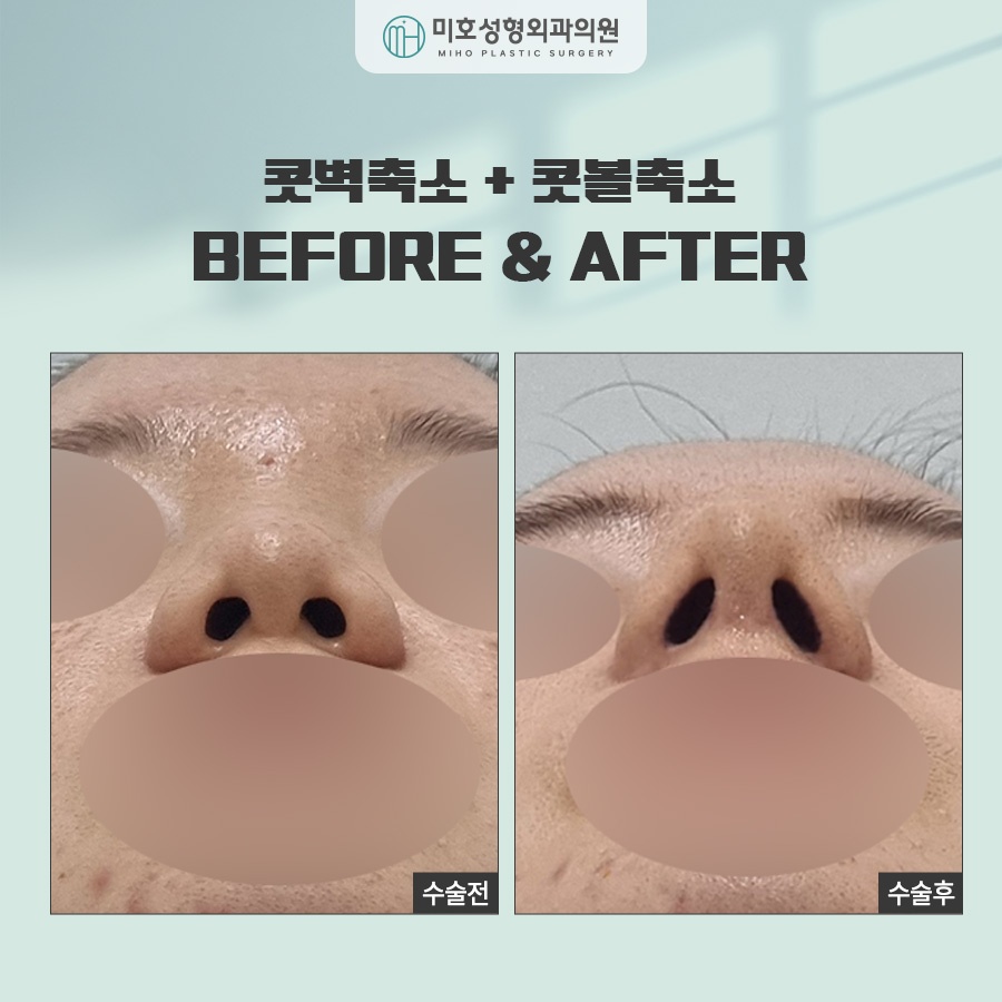Comprehensive Guide to Alar Reduction Procedure and Aftercare image 8