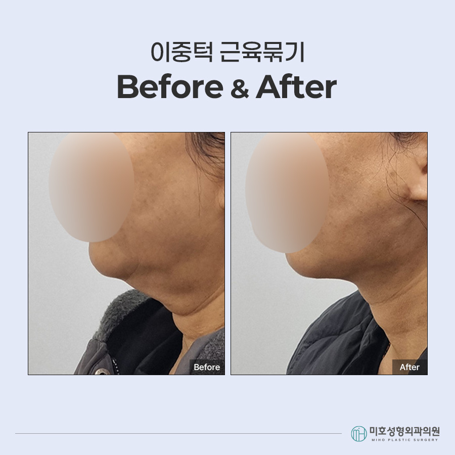 이중턱묶기란? 지방흡입과 차이부터 적합한 경우, 회복 과정까지 관련 이미지 8