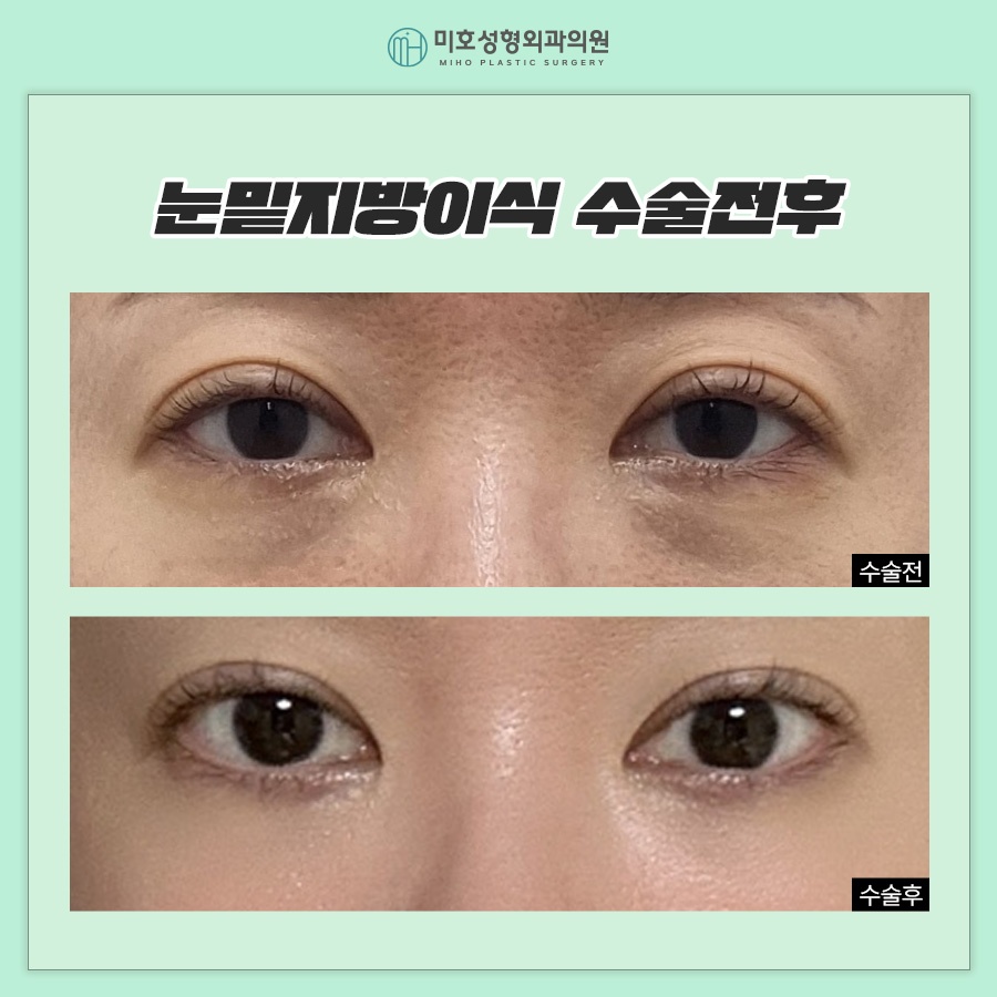 일반 눈밑지방이식과 나노지방이식의 차이점 관련 이미지 10