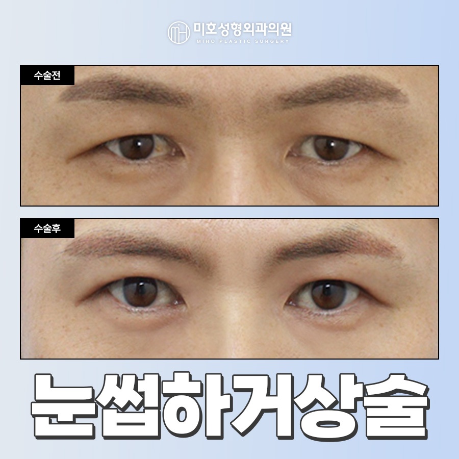눈썹하거상술 처진 눈 개선 관련 이미지 1