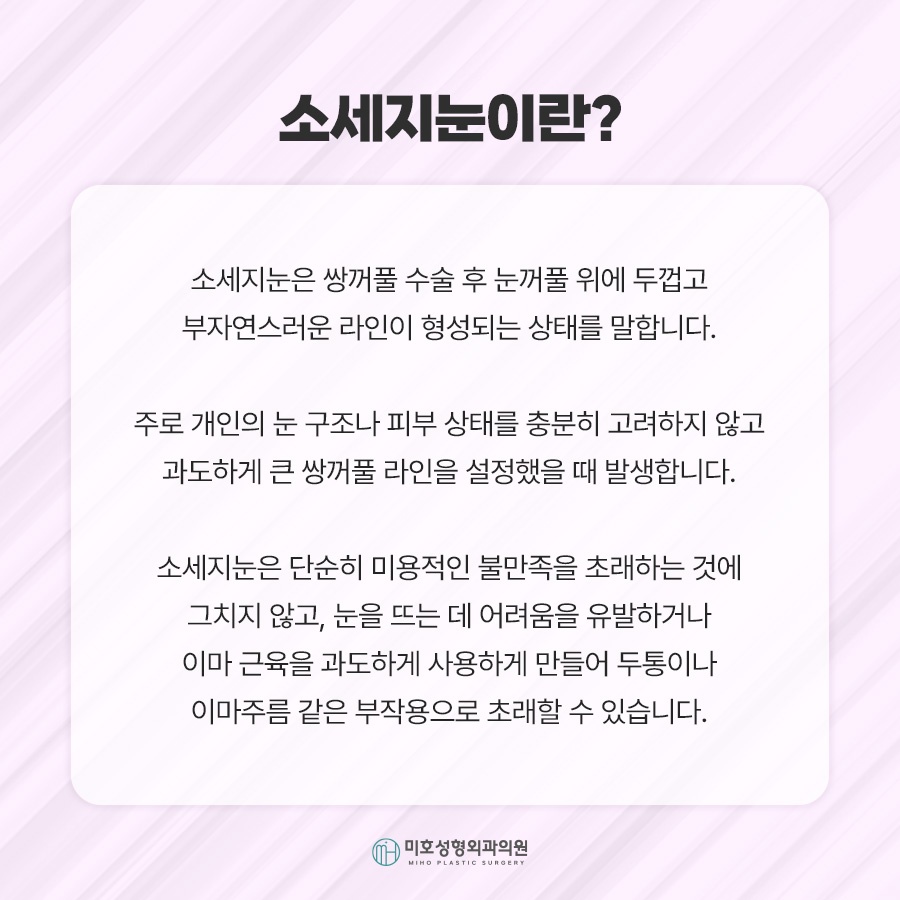 소세지눈재수술 적용 방식 2가지 관련 이미지 2