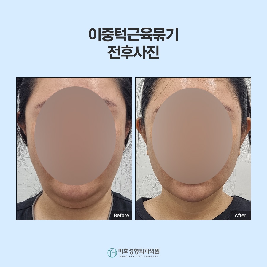 If the Jawline Beneath the Chin Looks Blurred: Double-Chin Muscle Tightening image 9