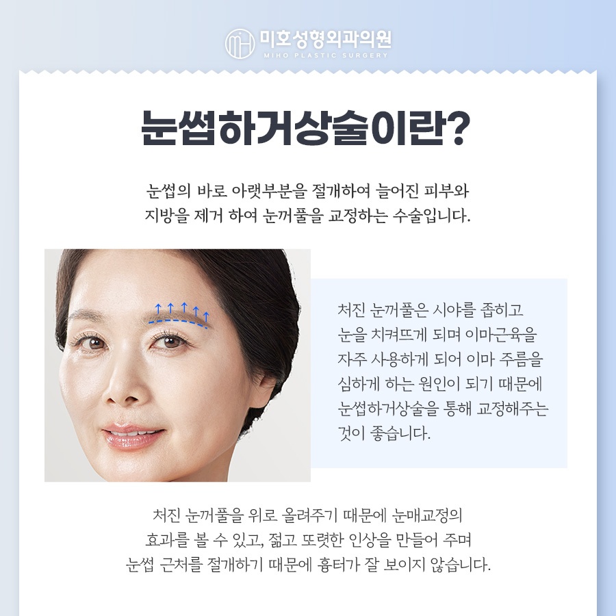 눈썹하거상술 처진 눈 개선 관련 이미지 2