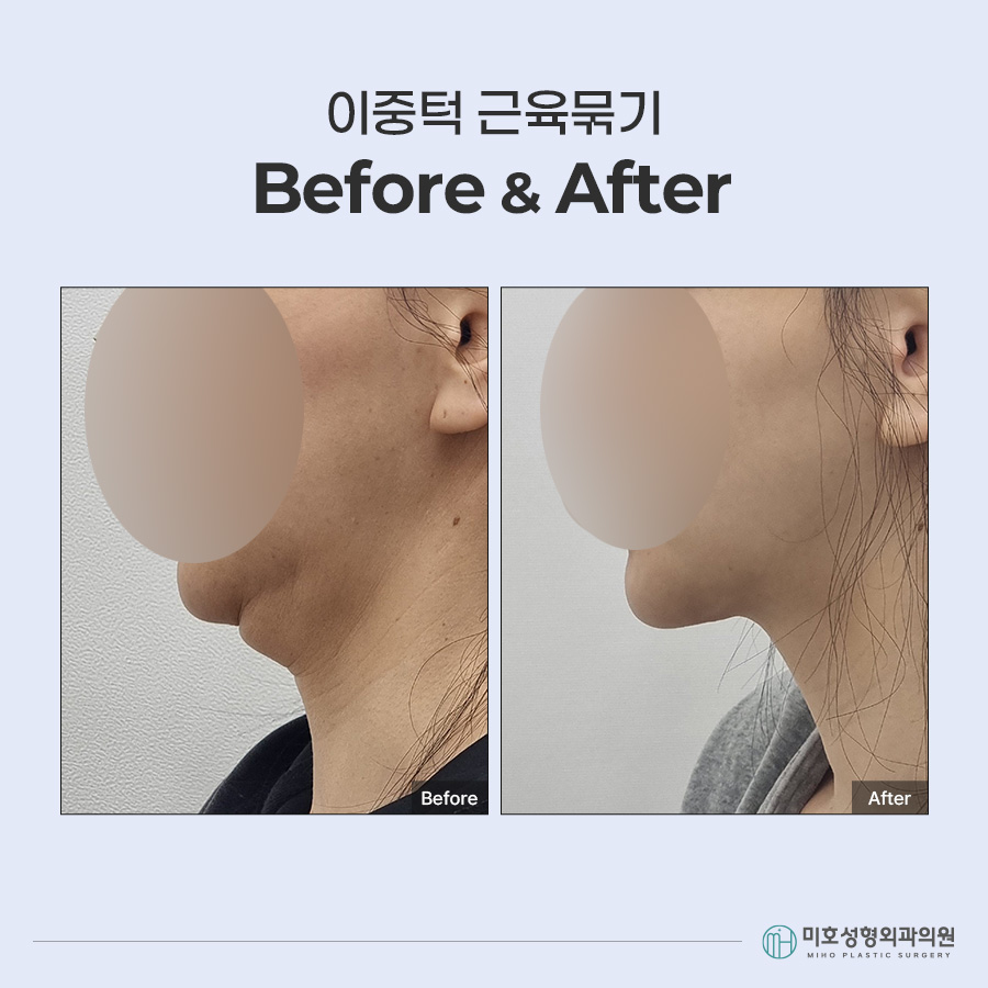 이중턱묶기란? 지방흡입과 차이부터 적합한 경우, 회복 과정까지 관련 이미지 7