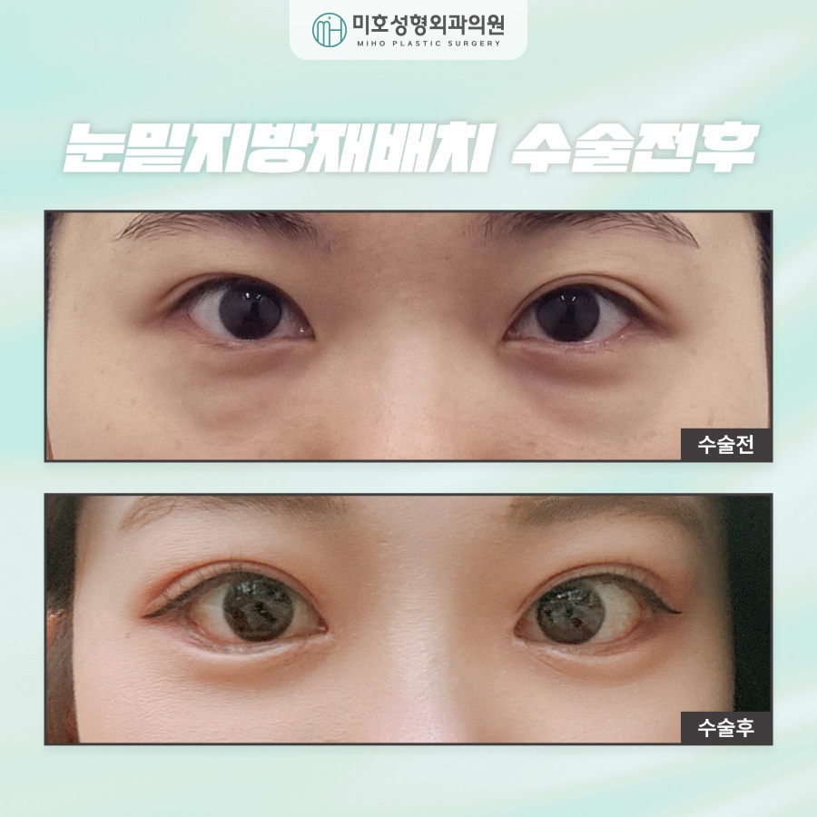 눈밑지방재배치후기 비교분석 하길 원한다면 관련 이미지 8