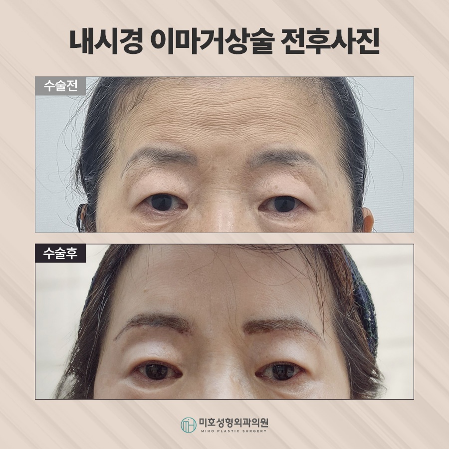 이마거상후기 진행과정 및 체크할 점 관련 이미지 10