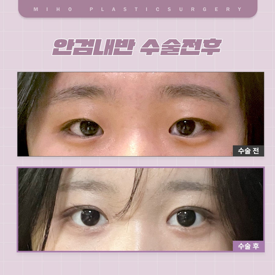 안검내반 속눈썹찔림 원인과 관리 관련 이미지 6